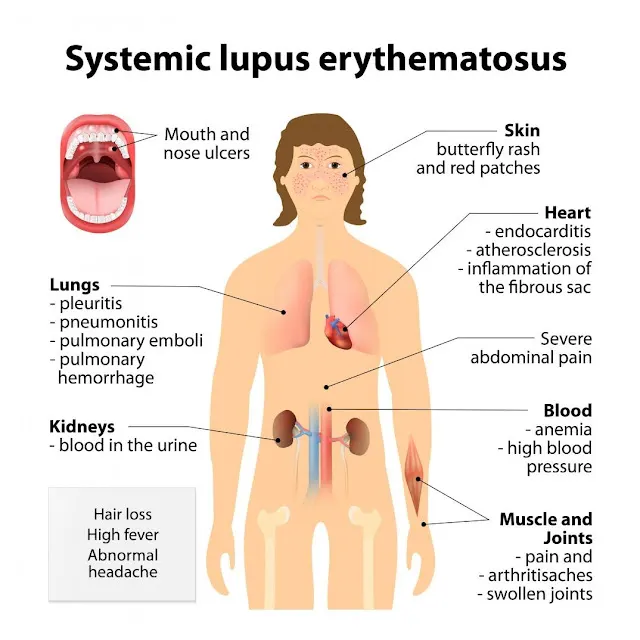 Lupus (SLE) Symptoms, Treatment and experience